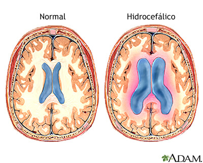 Hidrocefalia. La cirugía para la demencia tratable podría también ayudar en el Alzheimer. Hidrocefalia. La cirugía para la demencia tratable podría también ayudar en el Alzheimer.