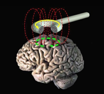 Un estudio apunta terapias magnéticas para enfermos de Alzheimer Un estudio apunta terapias magnéticas para enfermos de Alzheimer