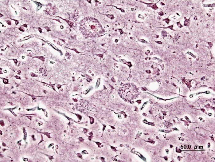 Corte histológico de corteza cerebral con Alzheimer (tinción con plata) donde se observan las placas seniles (Fuente: Wikipedia Autor: KGH)