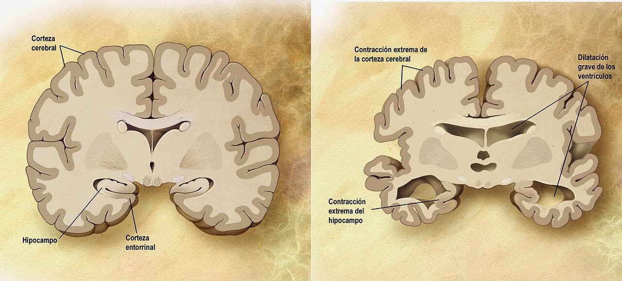 Comparación anatómica entre un cerebro normal (izquierda) y otro con la enfermedad de Alzheimer (derecha) (Fuente: Wikipedia Autor: ADEAR: "Alzheimer's Disease Education and Referral Center, a service of the National Institute on Aging.")