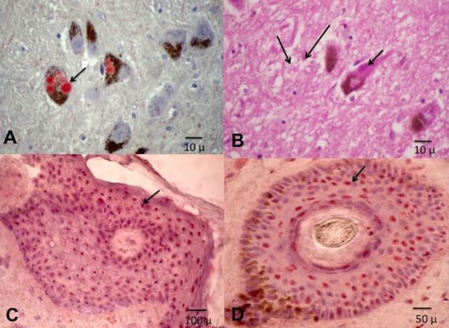 Vista superior. (A, B) Cerebro de un paciente con enfermedad de Parkinson. A: los agregados de alfa-sinucleína, denominados cuerpos de Lewy, en rojo. En B los cuerpos de Lewy se señalan con la flecha. Abajo, en muestras de piel. (C) los agregados α-sinucleína en células espinosas de la piel (flechas). En D, lo mismo en un folículo piloso emergente a través de la epidermis.