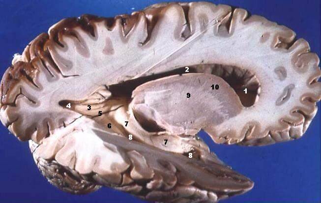 sustancia-blanca-cerebro-Human_brain_right_dissected_lateral_view_description Cambios en la sustancia blanca del cerebro