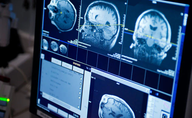 IRM de tumor cerebral IRM de tumor cerebral